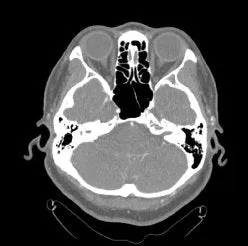 Skull Base Surgery Simulator